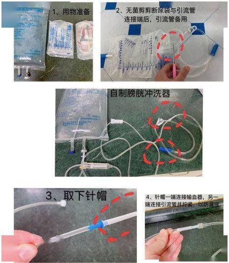 3 步轻松解除尿管堵塞,资深护士绝招大公开(有图)