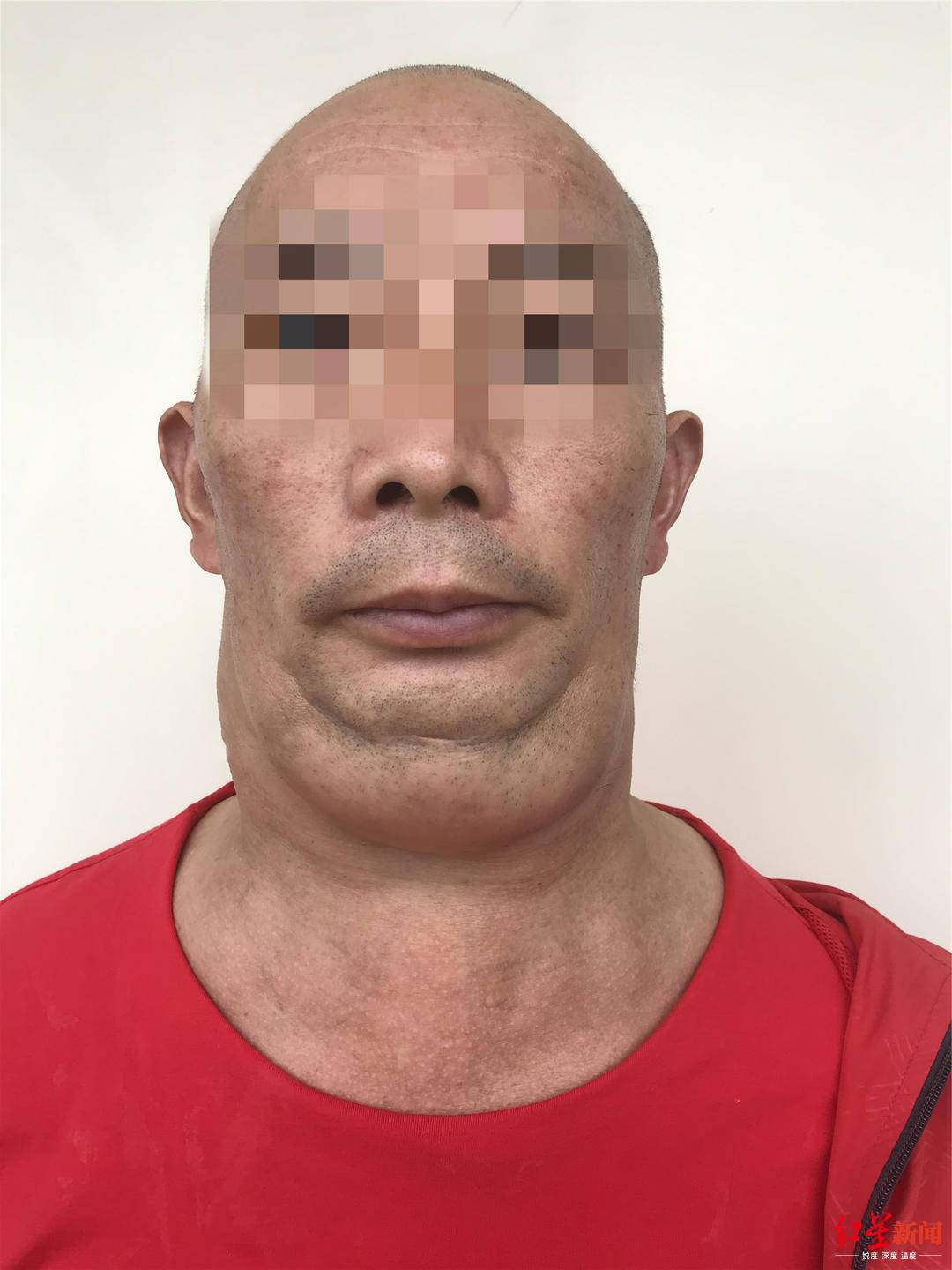 成都男子身患罕见马德龙病，全球仅约400例！