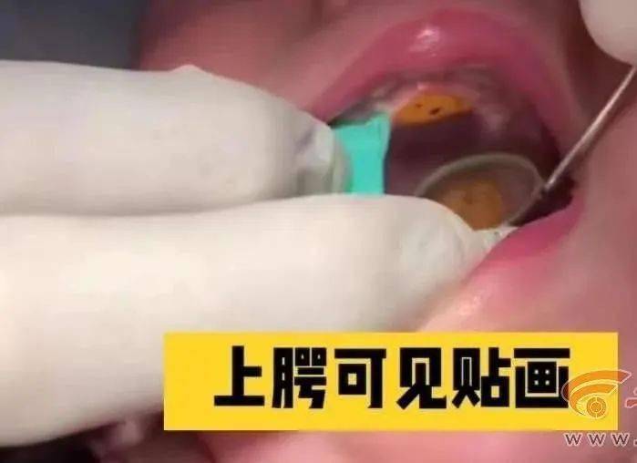 什么原因导致口腔粘膜脱落 31792bdebac74eeca0bb6075e8ef8464.jpeg