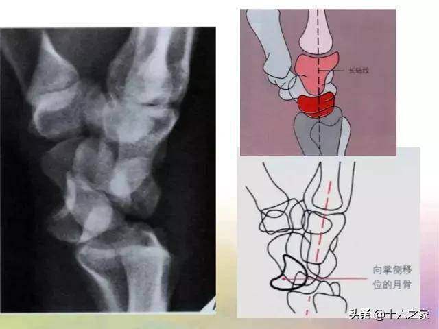 基础学习腕关节解剖详解