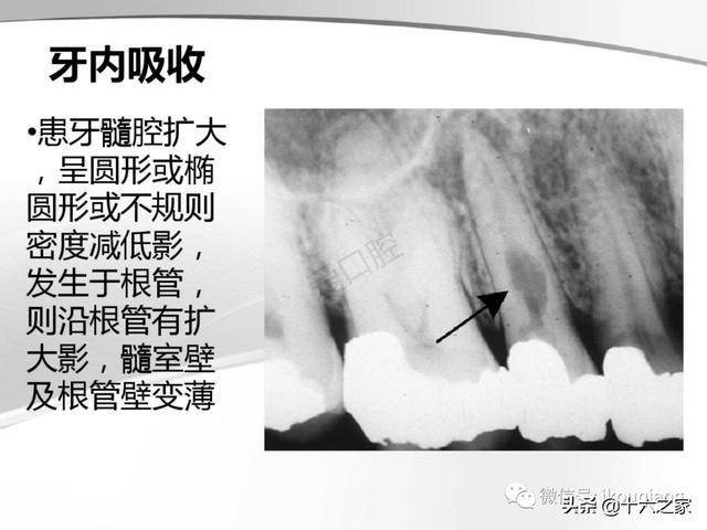 牙及牙周各种疾病影像学表现整理