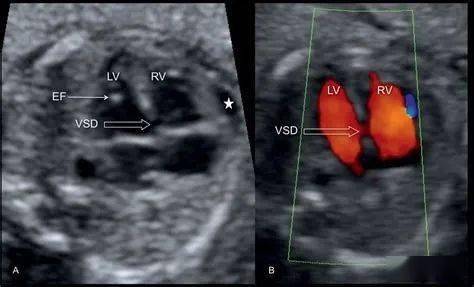 深化对胎儿室间隔膜部缺损的认识