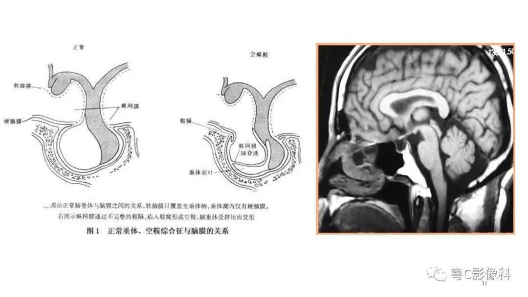垂体的正常mr表现及儿童垂体缩小病变的mr表现