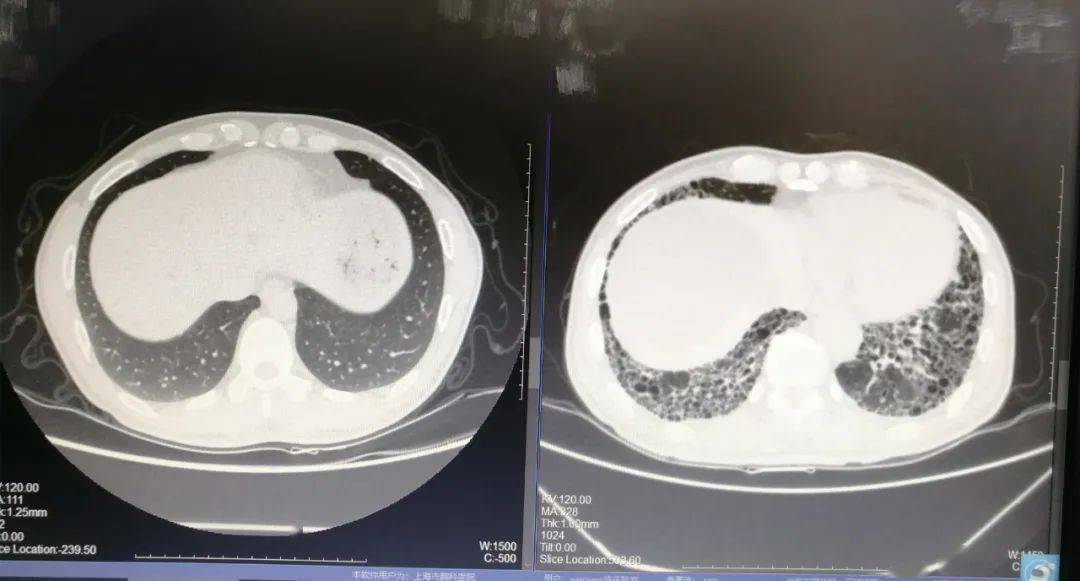左为正常的肺部ct右为特发性肺纤维化的肺部ct考虑到特发性肺纤维化