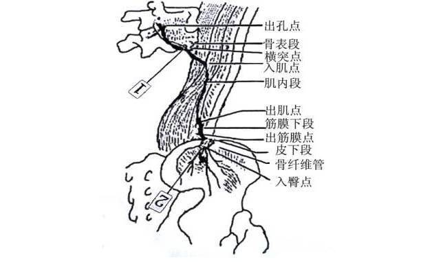 【教您一招】腰臀部疼痛针刀治疗——臀上皮神经卡压