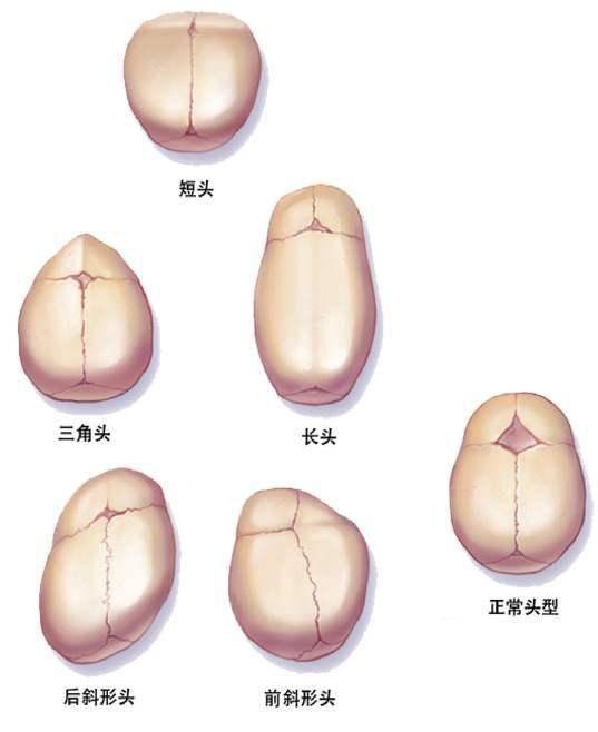 狭颅症(craniostenosis)又称颅缝早闭,是指一条或多条颅缝在生理闭合