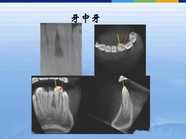 牙体牙周正常解剖及常见病x线表现