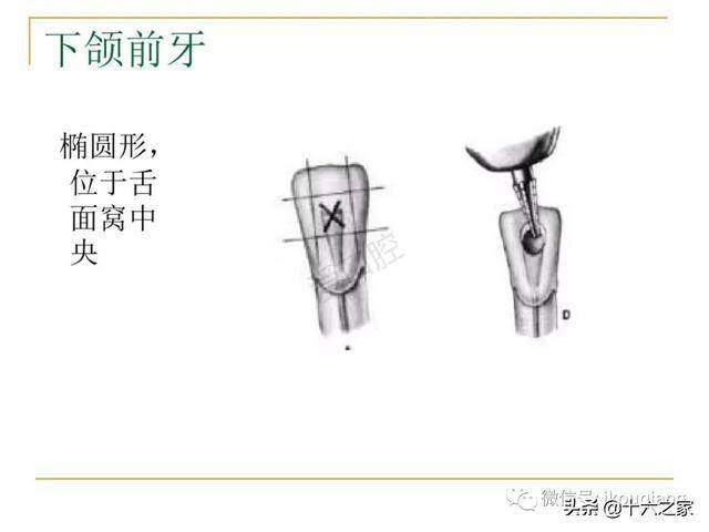 牙体髓腔解剖系统开髓开髓洞型及根管常用器械的认识和使用