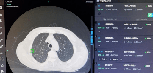 如何做低剂量肺部ct 0ba656bcde054b24ad4454ec574e685b.png