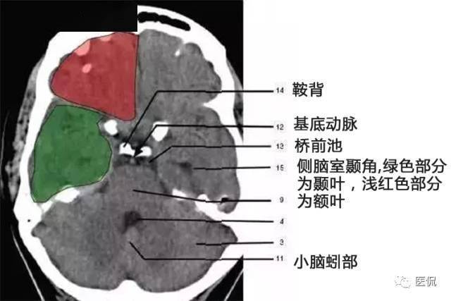 颅脑ct解剖口诀及彩色解剖图
