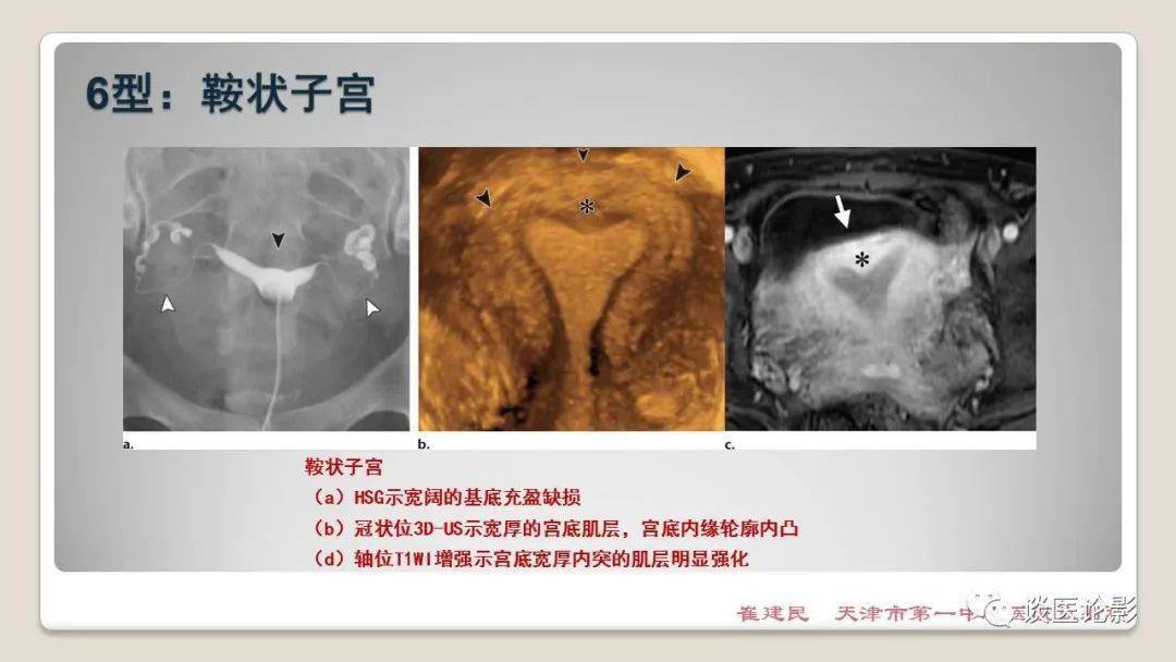 苗勒氏管畸形影像表现_子宫