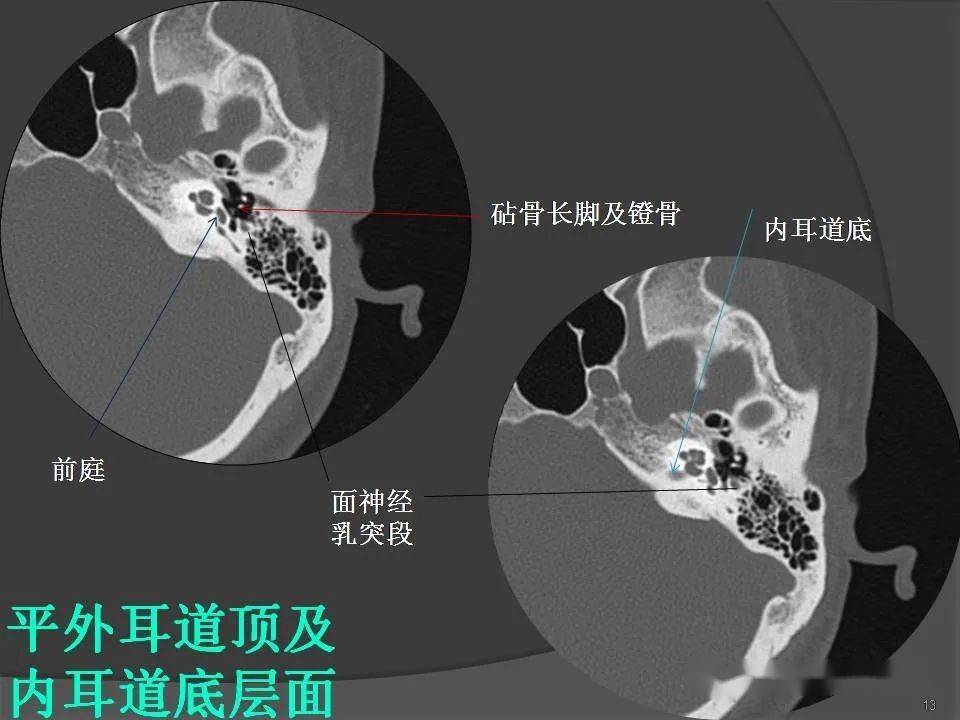 颞骨断层解剖及ct三维重建