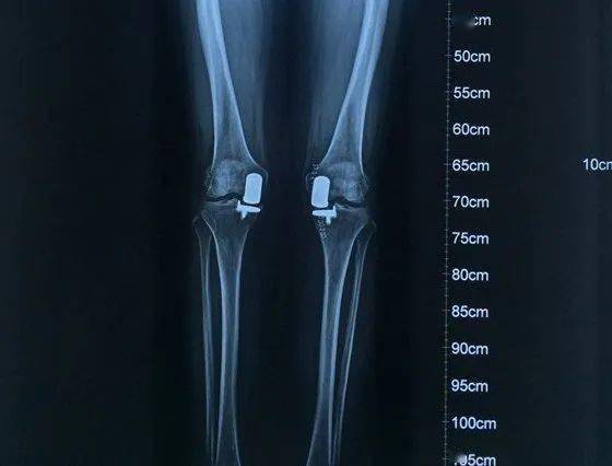 骨科| 膝关节骨性关节炎怎么治?