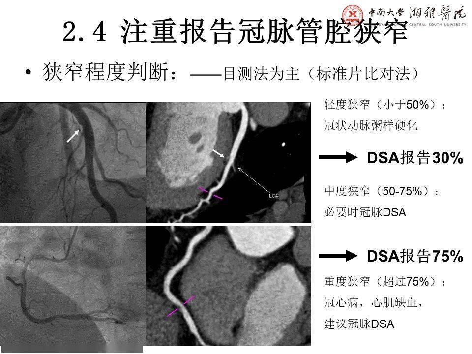 湘雅医院冠脉cta标准化后处理及规范化报告