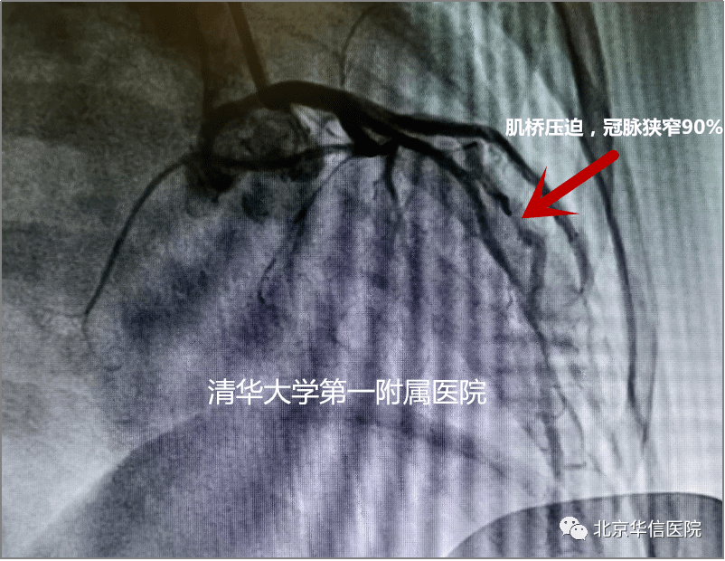 伴有心肌缺血,李小梅教授凭借丰富的临床经验,怀疑患儿存在冠脉肌桥