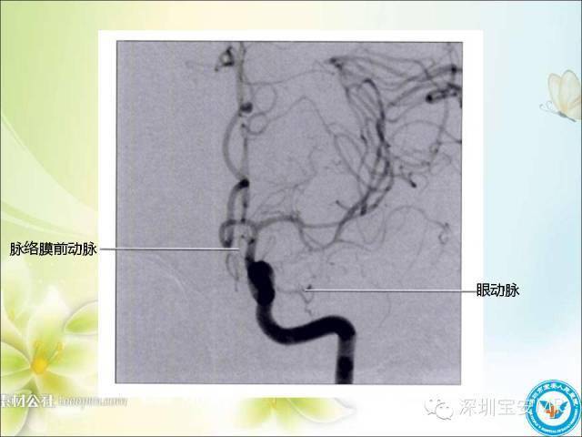 收藏丨颈内动脉颅内段影像解剖附临床血管病例