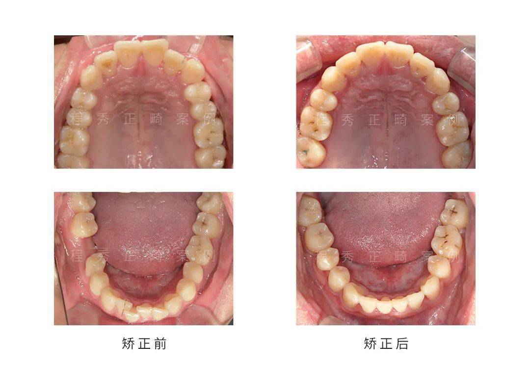 案例分析矫正关闭缺牙间隙省下种植费用案例