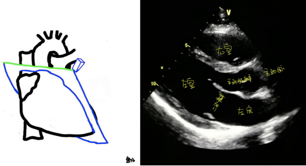 心尖图文详解 | 心超切面不会打？看这一篇就够了！
