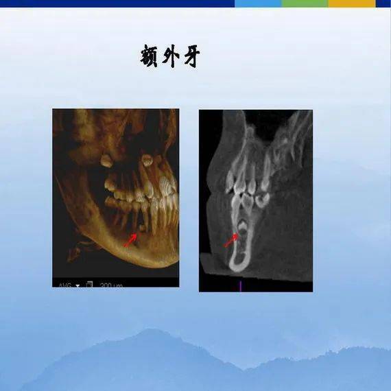 牙体牙周正常解剖及常见病x线表现