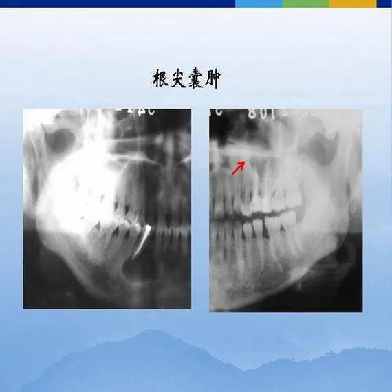 牙体牙周正常解剖及常见病x线表现