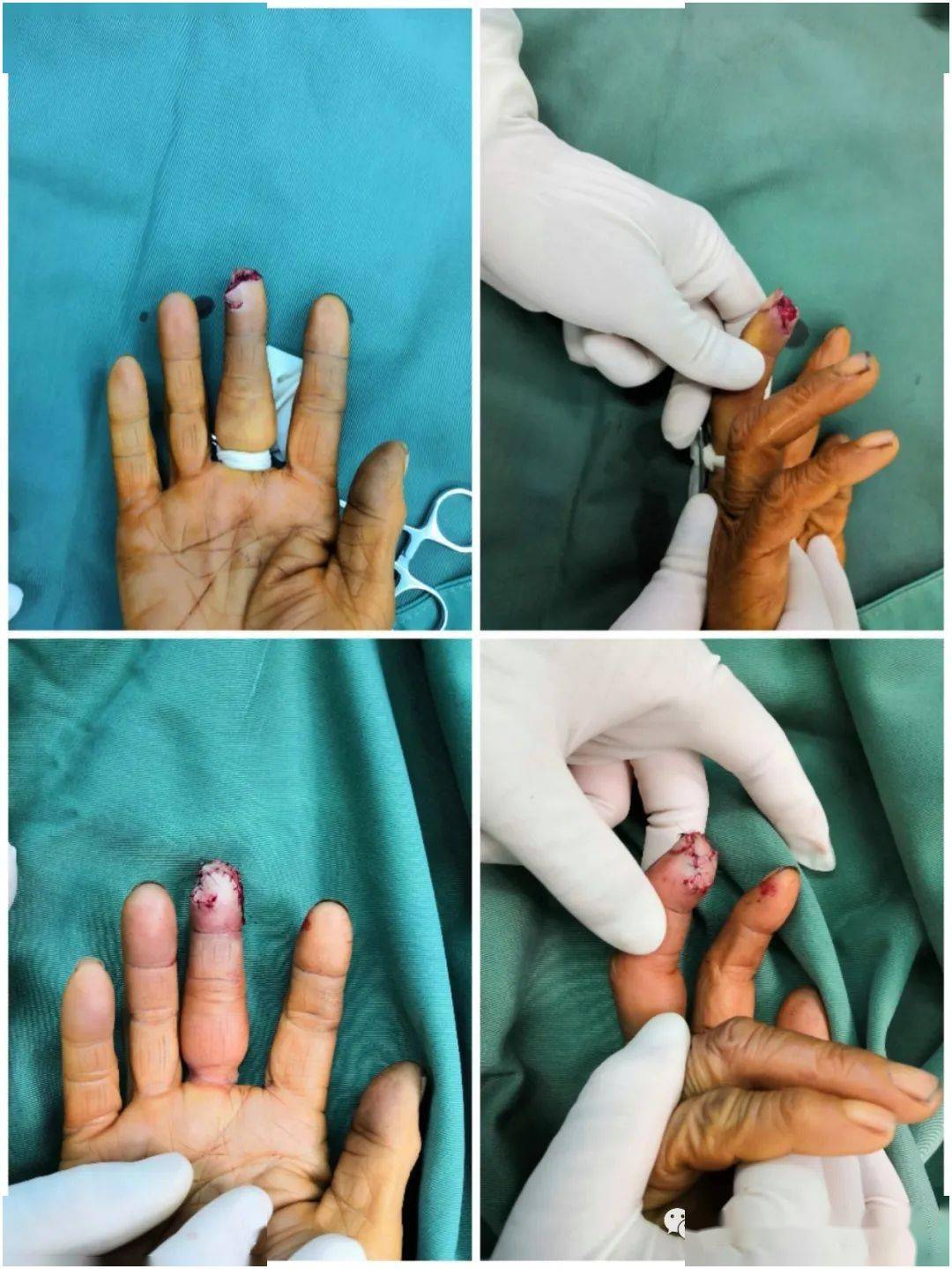 微型皮瓣塑造完美手指,患者直夸好_手术