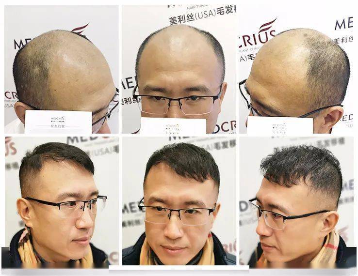 遗传性脱发13年这位的哥一次选择后竟然实现了巨大改变值得脱发人群