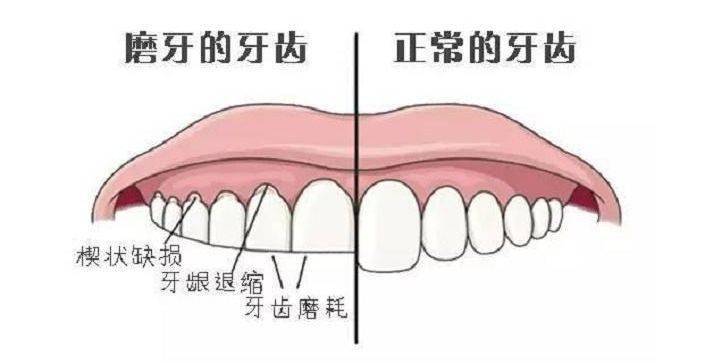 为什么你晚上睡觉会磨牙?