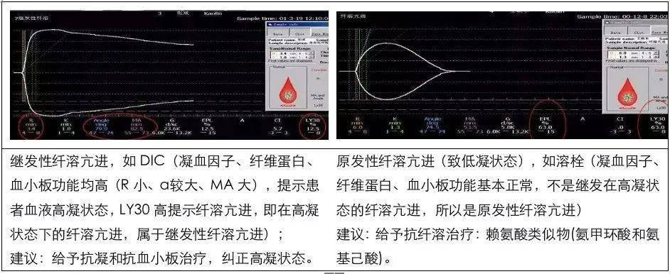 掌握这 4 个问题,轻松读懂血栓弹力图