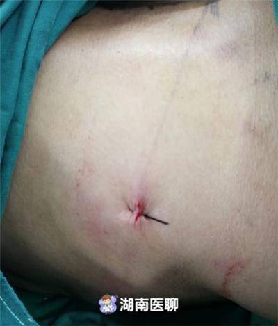 治疗腰椎间盘突出只能开刀？no，微创手术切口不到1cm解痛苦