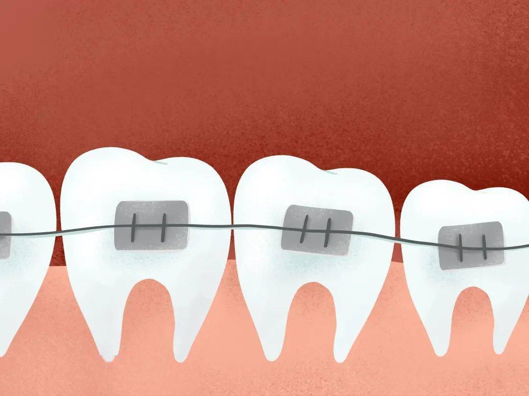 牙齿矫正价格降低一半,年轻人距离「牙套自由」还有多远?