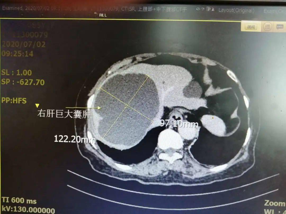 85岁老人腹痛难忍,一查发现肝脏五分之三都是水!