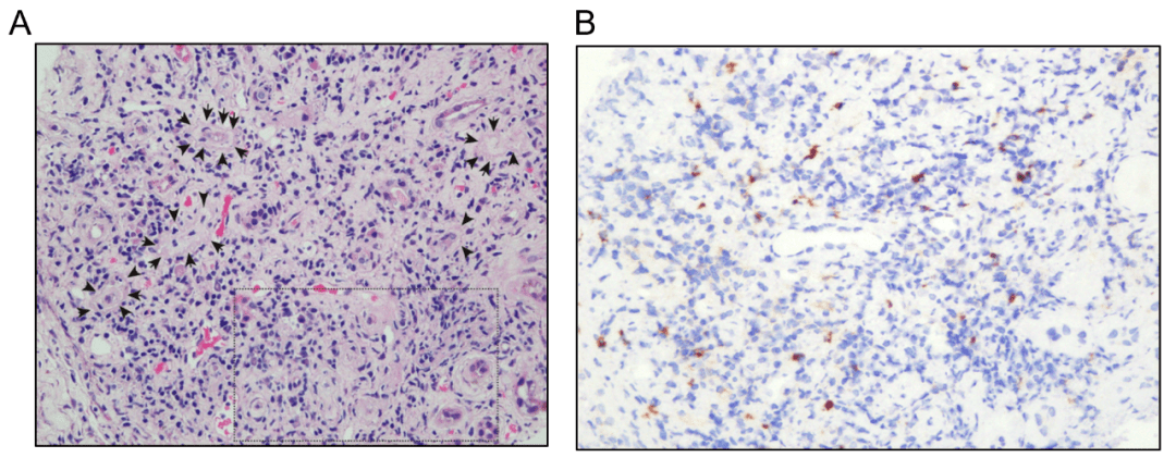 淋巴结|血肌酐升高，腹股沟淋巴结越来越大，一查竟是......