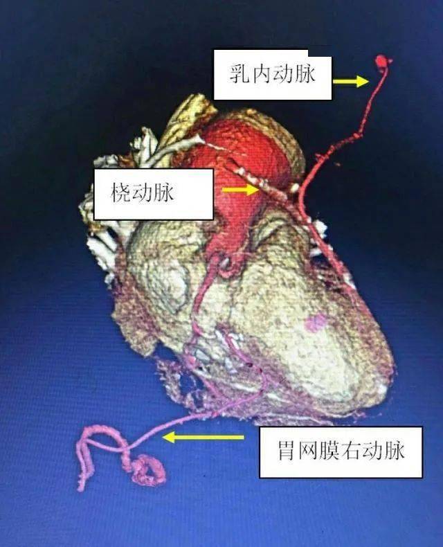 分别取左侧乳内动脉,左侧桡动脉及胃网膜右动脉,搭了