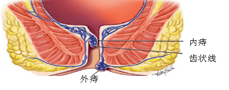 健康丨屁屁有点疼,原来是它在作祟_肛门