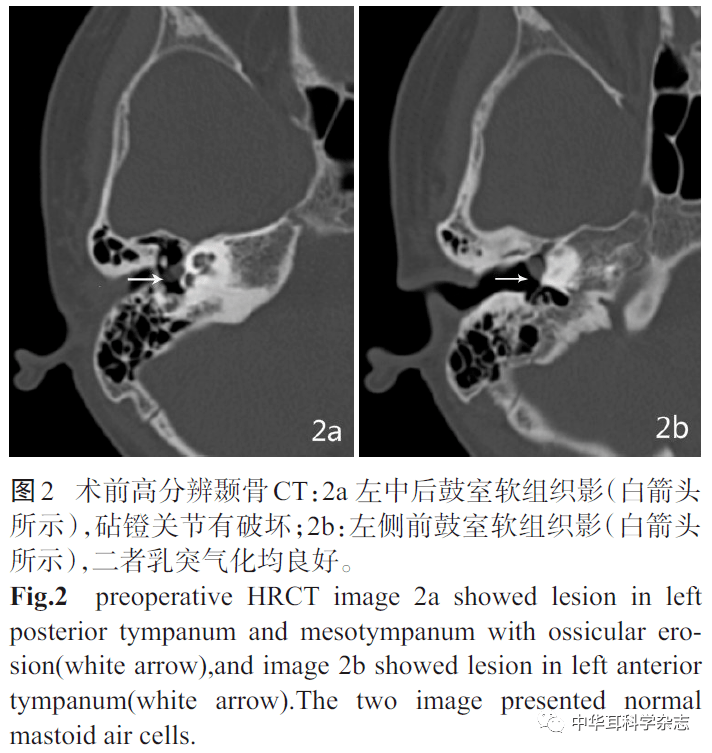 耳内镜下处理先天性中耳胆脂瘤的临床疗效分析