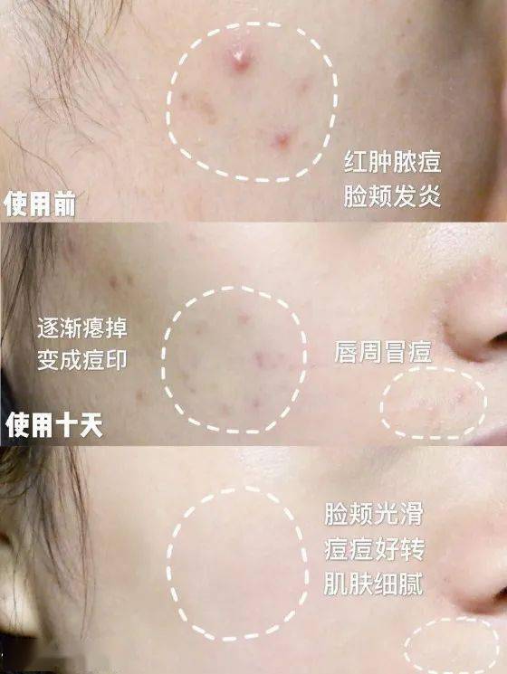 黑头|沈梦辰没骗我！HFP这些宝藏单品，真的让我“一夜换脸”！