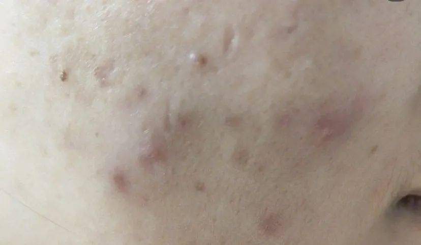 皮肤|用它点一点，痘印、斑点竟然没了，难怪李佳琦都为它疯狂打call！