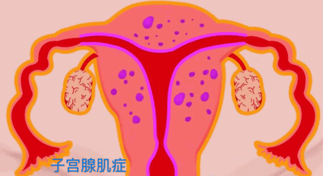 如下图所示:子宫腺肌症简单说,就是指子宫内膜(基底层的腺体和间质)长