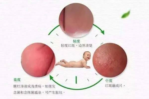 宝宝反复红臀,红屁股?宝妈这样做,就能迅速解决!