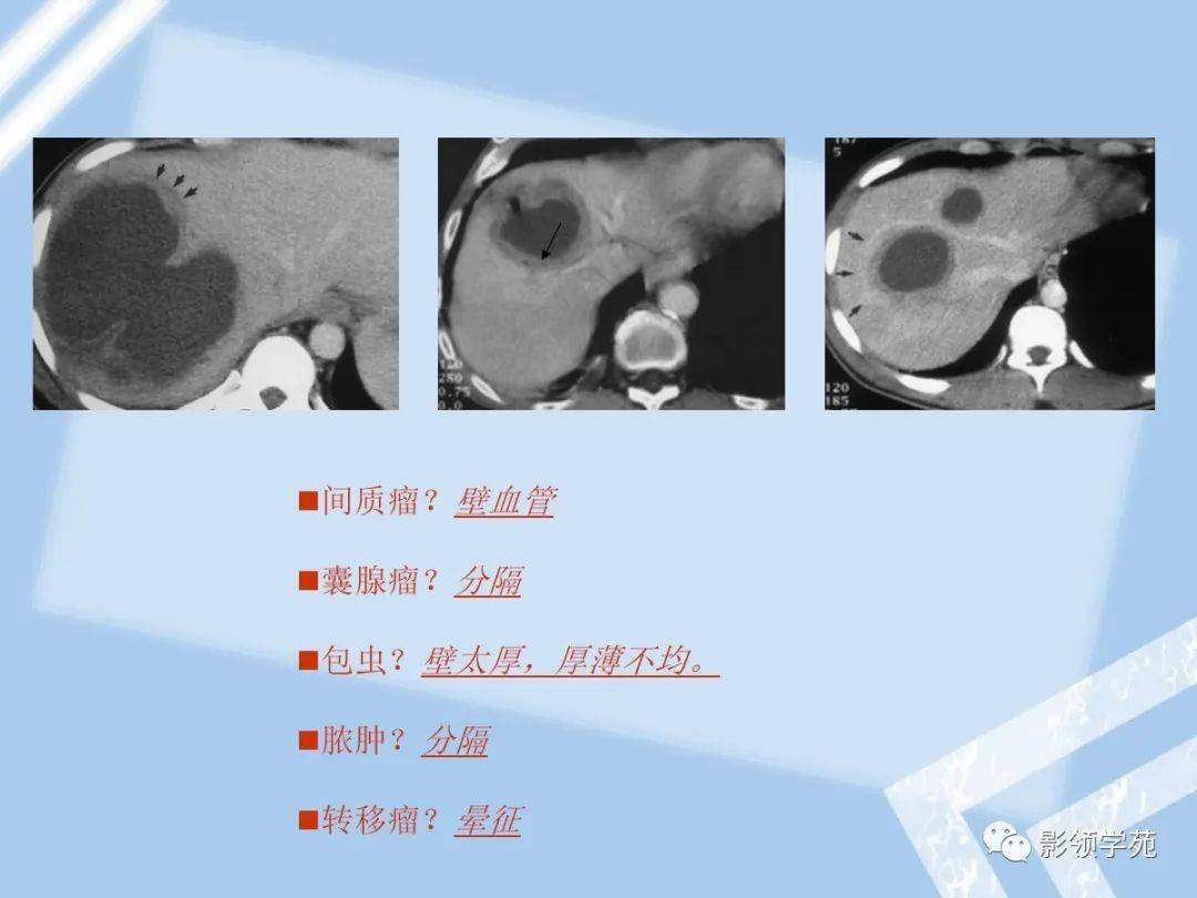 肝囊肿与单纯囊肿型肝包虫病在ct表现上较难鉴别,因无钙化和子囊而被