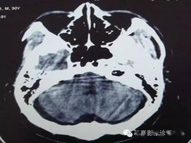 大枕大池的影像表现及鉴别诊断