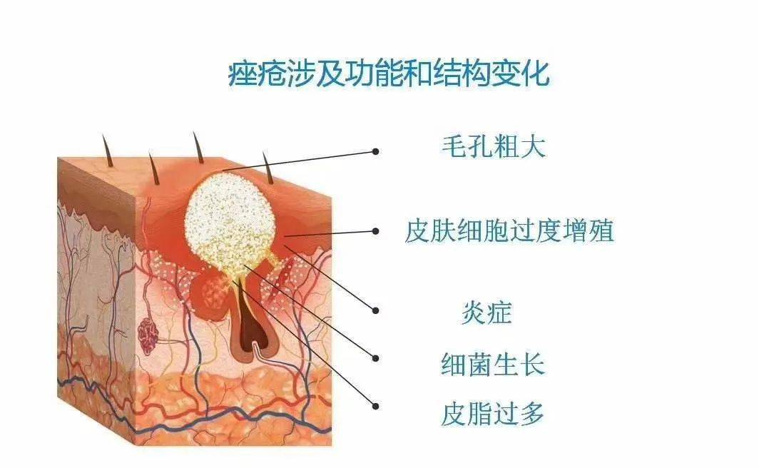 同一位置反复长痘皮肤底层的炎症一直跟随着你