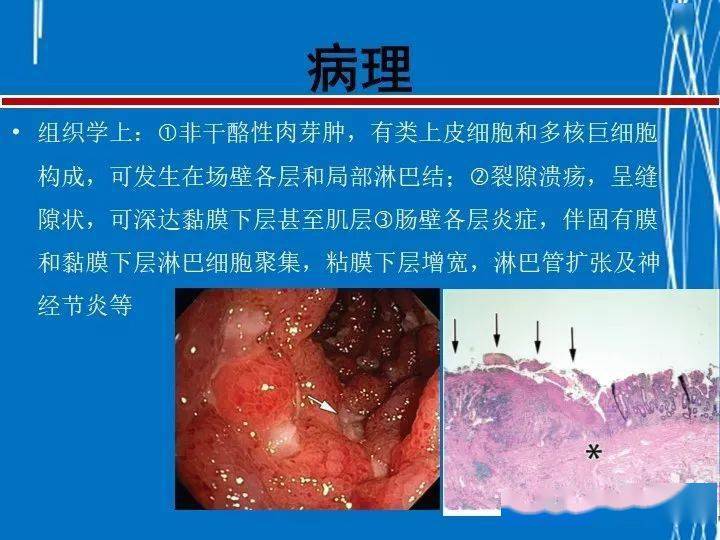 克罗恩病ct,mri表现及鉴别诊断