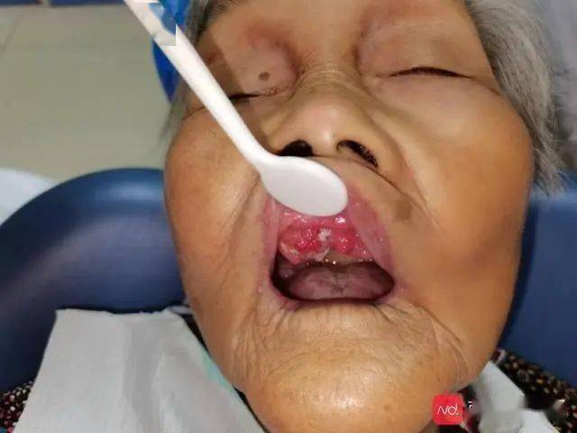 【新闻】假牙下"长肉",竟是口腔癌!医生巧手为百岁老人摘除口腔肿瘤