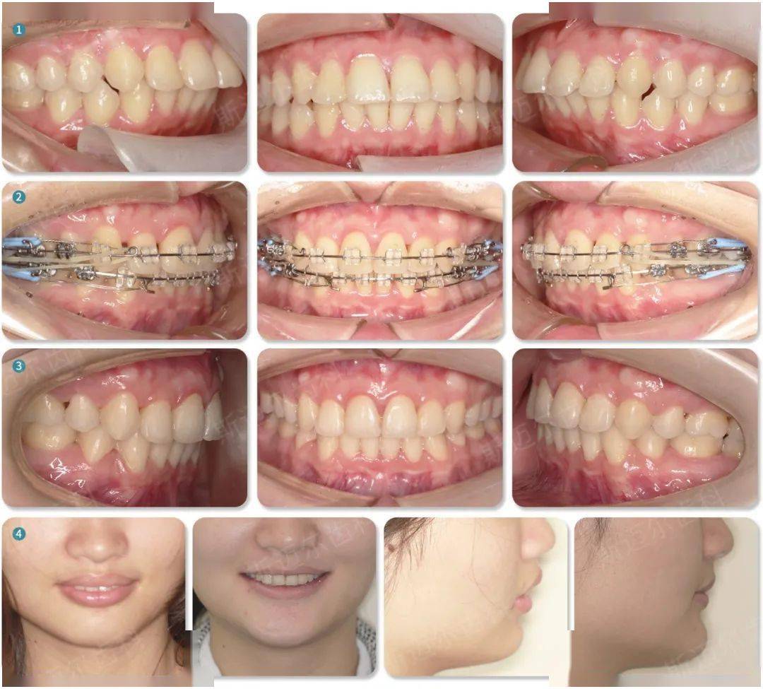 案例分析:主要解决前突问题,通过拔牙创造空间内收牙齿,同时解决嘴突