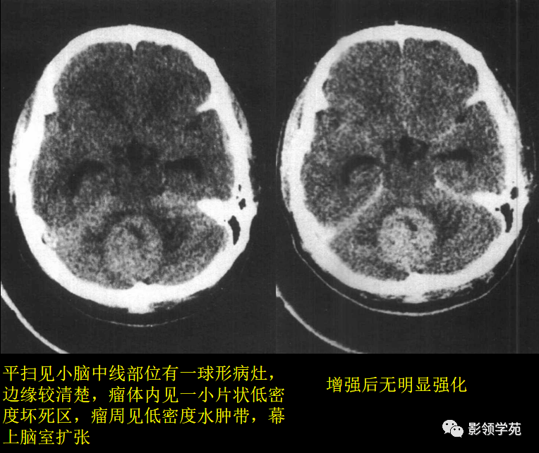 单发多见ct表现:(1)平扫见小脑或者脑干低密度囊性肿 块,可呈球形