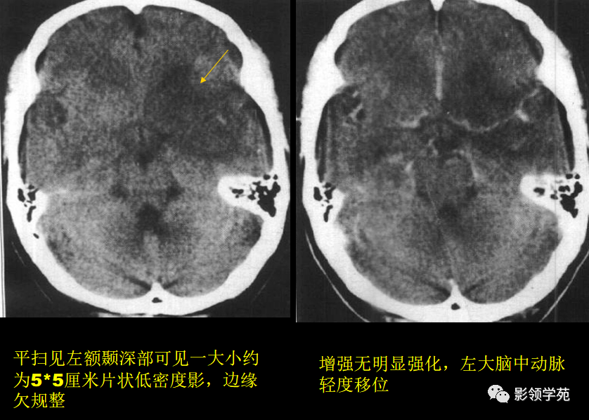 ct平扫为囊性低密度病变,边界清楚,肿瘤实性部分或壁结节密度与脑