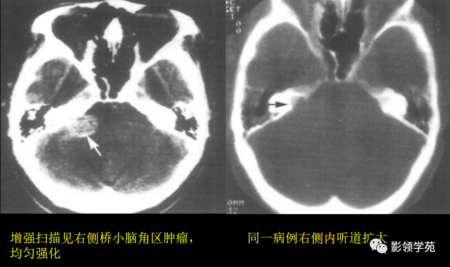 15中常见颅内肿瘤的ct表现