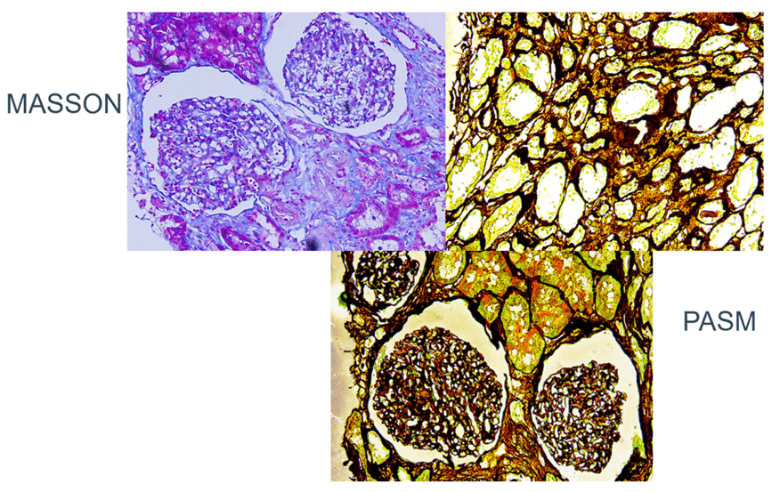 治疗|ARNI，心肾综合征治疗的新希望?