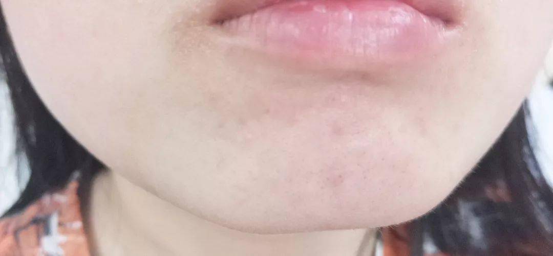 灭火器|1滴让你爱上!从满脸爆痘到光滑无瑕,我只用了这瓶火爆ins的“痘痘灭火器”!